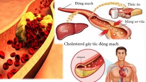 Loại bỏ cholesterol - Nguyên nhân nhồi máu cơ tim, đột quỵ cùng Tỏi đen Kochi